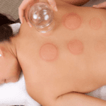 A women having a cupping session.