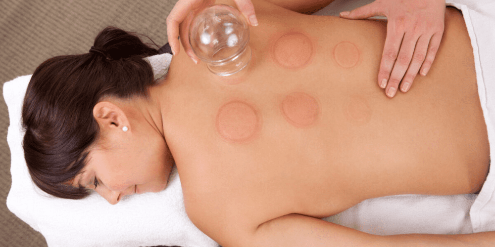 A women having a cupping session.